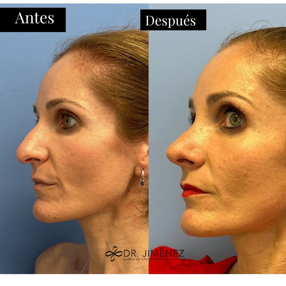 Before and After Result